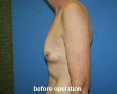 plastic-surgery-breast-augmentation